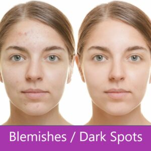 Blemishes / Dark Spots
